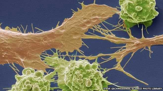 Bowel Cancers Spotted too late