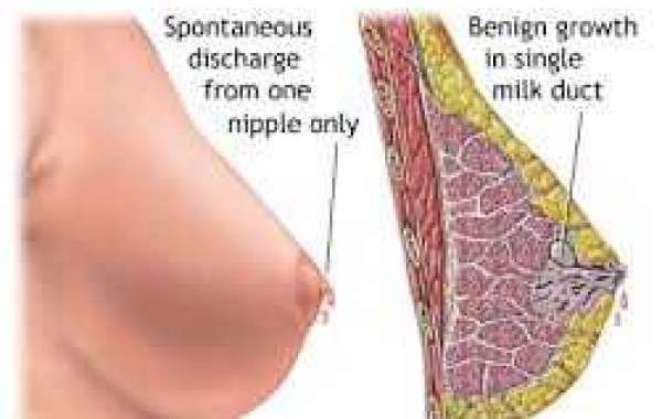 Bleeding nipple နို့ကနေသွေးထွက်ခြင်း