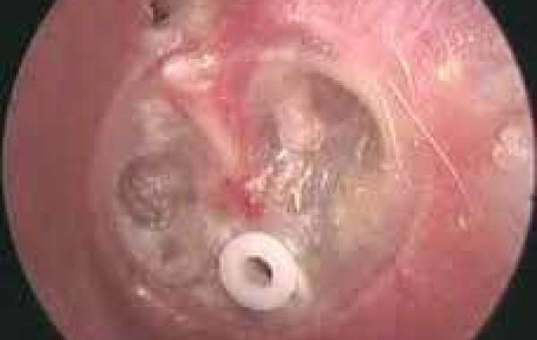 Fluid in the ear နားထဲမှာအရည်ရှိတာ