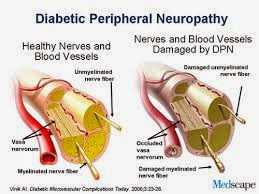 Diabetic neuropathy