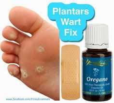Plantar Warts Treatment