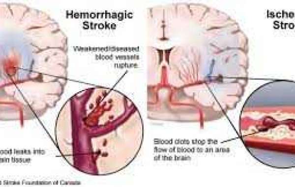 Stroke ဦးနှောက်သွေးကြော ဖောင်းပြီးပေါက်ခြင်း