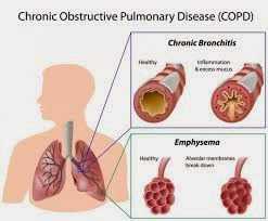 COPD