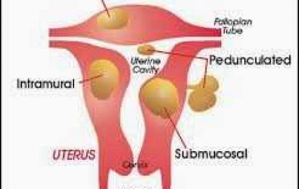 Submucous fibroids သားအိမ် အတွင်းလွှာက အလုံး