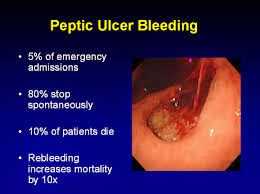 Bleeding Peptic Ulcer