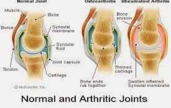 Arthritis အဆစ်နာ