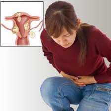 Fibroids Cure without losing Uterus
