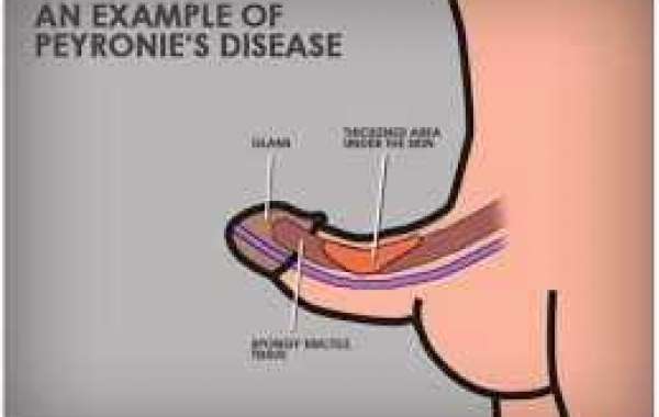 Peyronie's Disease ကျား-လိင်အင်္ဂါ ကောက်နေခြင်း