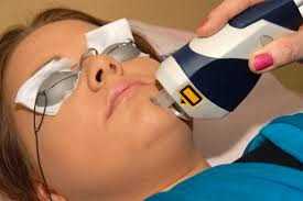 Acne Laser treatment