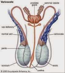 Varicocele