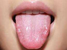 Tongue cancer