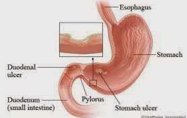 Peptic Ulcer Diagnosis လေနာရောဂါကို ဆေးစစ်ခြင်း