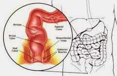 Proctitis