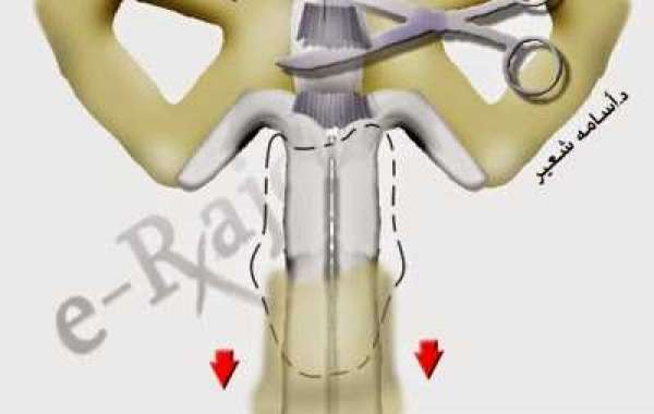 Penis size and enlargement surgery ကျားအင်္ဂါခွဲစိတ်ကုသနည်း