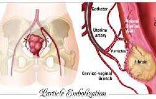 Uterine Fibroid Embolization (UFE) သားအိမ်အလုံးကို သွေးကြောပိတ်နည်းနဲ့ကုသခြင်း