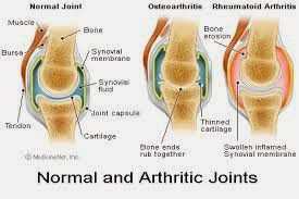 Arthritis