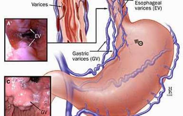 Esophageal varices အစာမျိုပြွန်သွေးကြောပေါက်ခြင်း