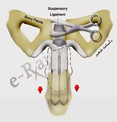 Penis size and enlargement surgery