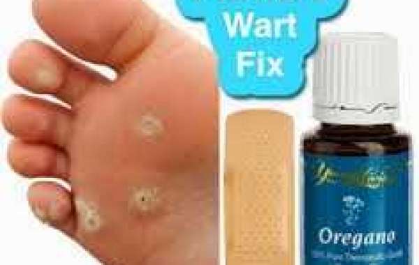 Plantar Warts Treatment ခြေဖဝါး အသားမာ ကုသနည်း