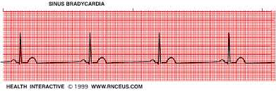 Triglyceride and Sinus bradycardia