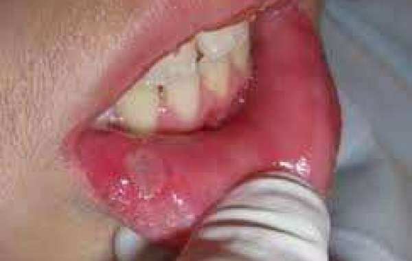 Aphthous ulcer and Fissured tongue လျှာနာ အာနာ