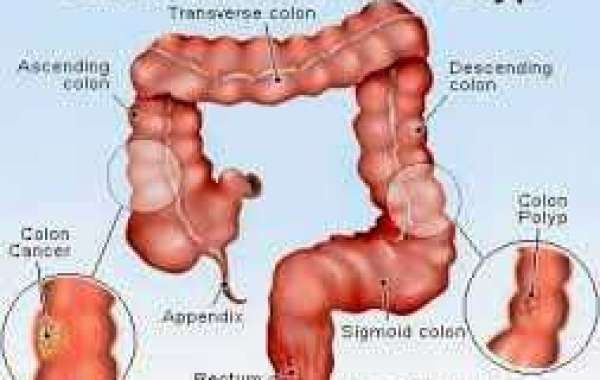 Colorectal cancer အူမကြီး ကင်ဆာ