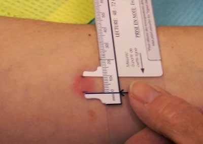 Tuberculin test