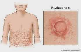 Pityriasis rosea