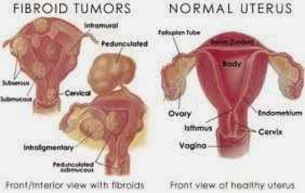 Uterine Fibroid Treatments သားအိမ်အကျိတ်ကုသနည်း အမျိုးမျိုး