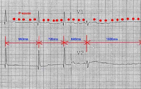 Supraventricular Tachycardia နှလုံးခုန်မြန်ရောဂါ