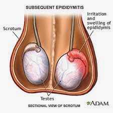 Epididymitis and Orchitis