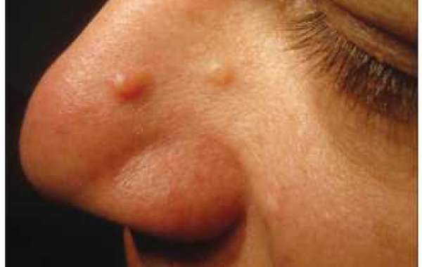 Fibrous papule of the face မျက်နှာငါးမျက်စိ
