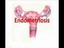 Endometriosis