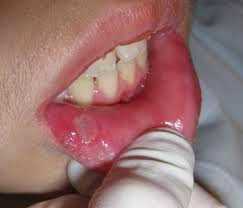 Aphthous ulcer and Fissured tongue