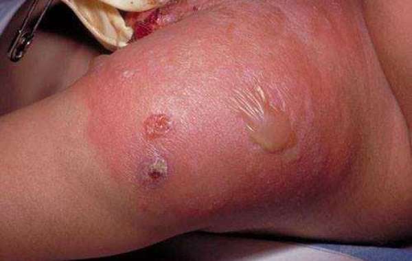 Cellulitis (သို့) Erysipelas