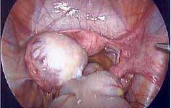 Ovarian teratoma မျိုးဥအိမ်အကျိတ်တမျိုး