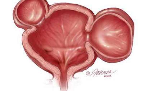 Bladder diverticulum ဆီးအိမ် ဒိုင်ဗာတီကူလမ်