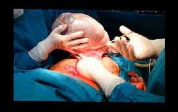 Ovarian cysts မျိုးဥအိမ်အိတ်များ