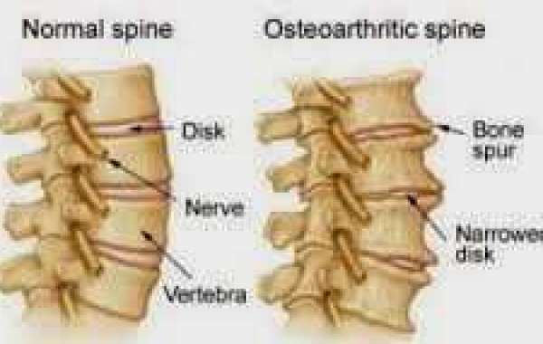 Osteophytosis အရိုးရောဂါတမျိုး