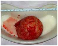 Uterine Fibroid