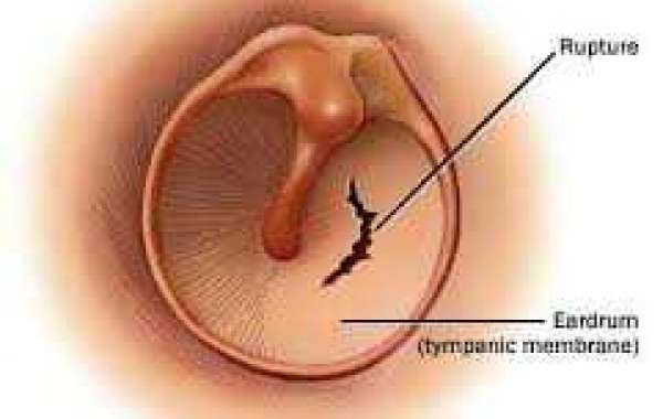 Perforated eardrum နားစည်ပေါက်ခြင်း