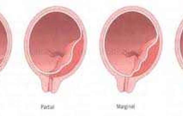 Placental Previa အချင်းရှေ့ရောက် အမေး
