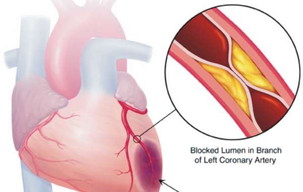IHD နှလုံးသွေးကြောကျဉ်းရောဂါ (Ischemic Heart Disease)