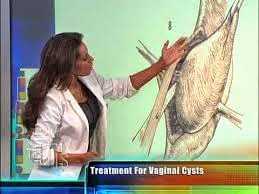 Vaginal Cysts Polyps Warts