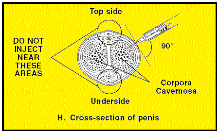 Penis Injection Risks
