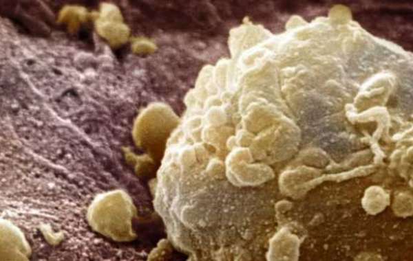 Cancer Drug Combination Shrinks 60 Percent of Melanomas