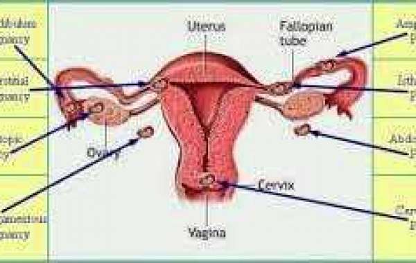 Pregnancy outside the Uterus ထူးဆန်းသည့် ကိုယ်ဝန်