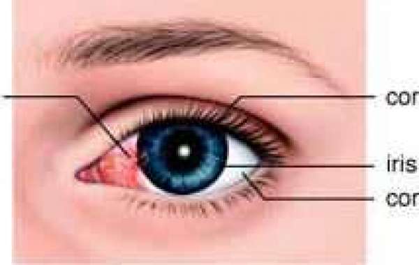 Pterygium မျက်သားတက်ခြင်း