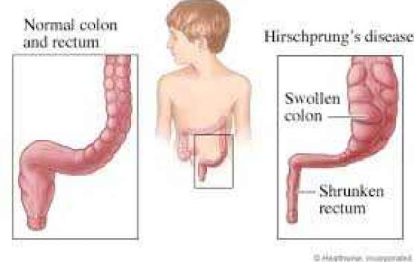 Hirschsprung Disease မွေးရာပါအူပိတ်ရောဂါတမျိုး