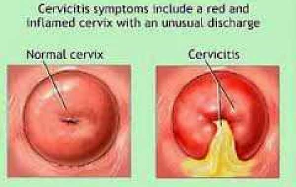 Cervicitis သားအိမ်ဝ ရောင်ခြင်း